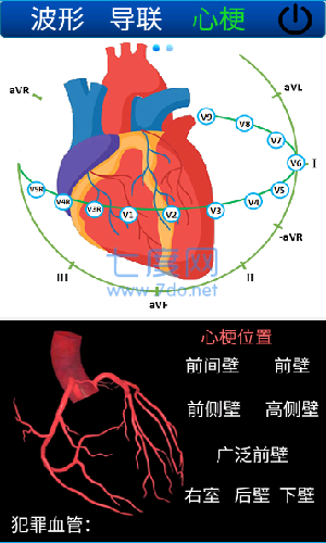 心电图ECG